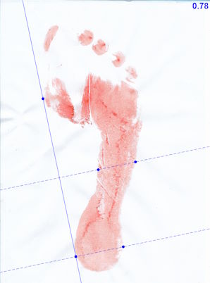 Staheli arch index measurement